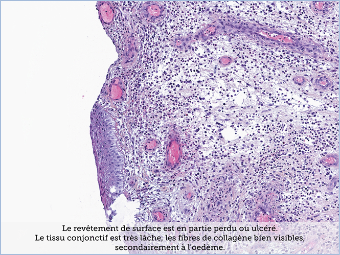 FICHE 2 TUMEUR WARTHIN ECRAN A