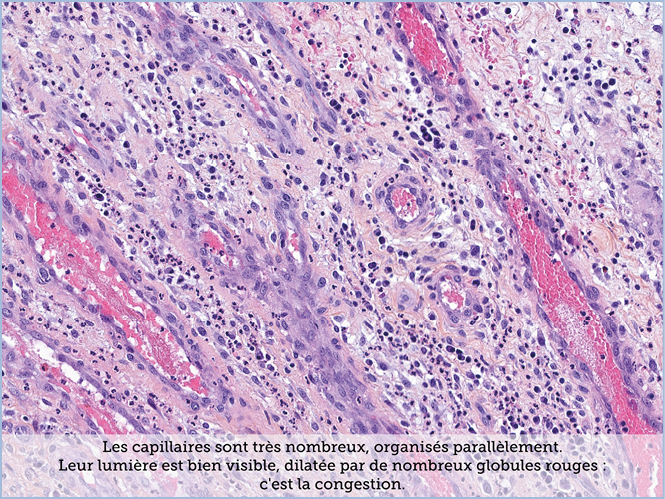 FICHE 2 TUMEUR WARTHIN ECRAN B