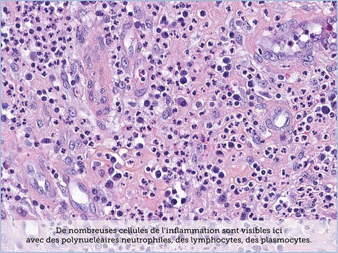 FICHE 2 TUMEUR WARTHIN ECRAN C