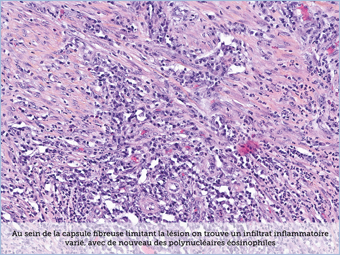 FICHE 2 TUMEUR WARTHIN VIDEO