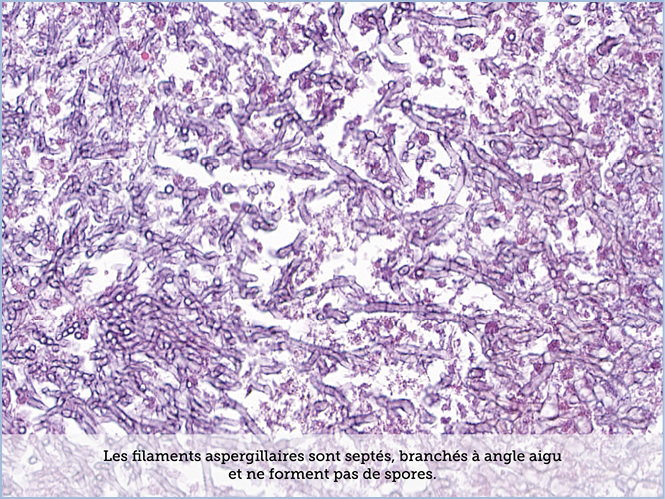 FICHE 2 TUMEUR WARTHIN ECRAN C