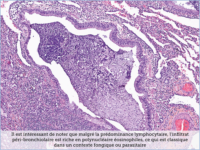 FICHE 2 TUMEUR WARTHIN ECRAN A