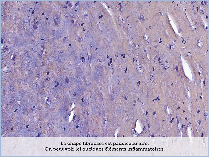 FICHE 2 TUMEUR WARTHIN VIDEO