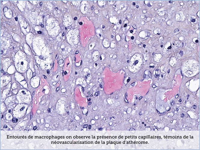 FICHE 2 TUMEUR WARTHIN ECRAN C