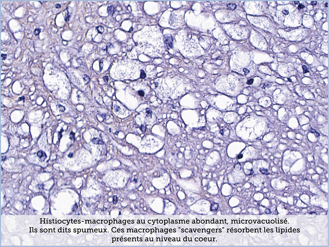 FICHE 2 TUMEUR WARTHIN ECRAN B