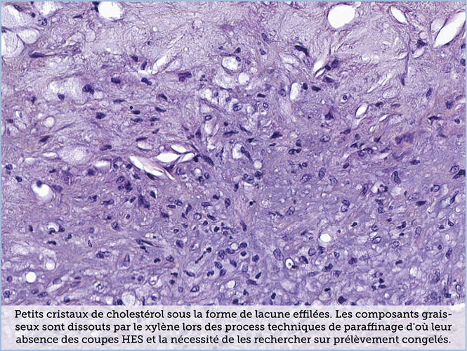 FICHE 2 TUMEUR WARTHIN ECRAN A