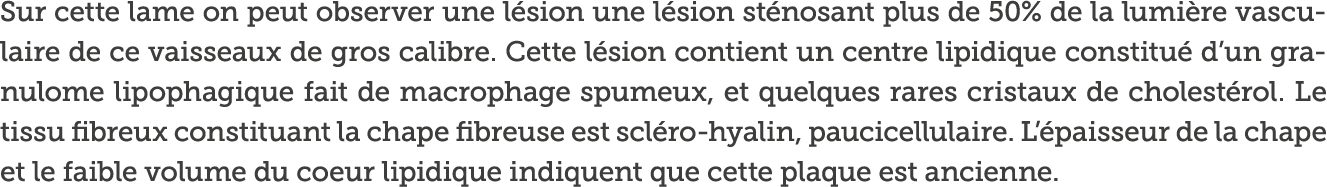 Sur cette lame on peut observer une l sion une l sion st nosant plus de 50  de la lumi re vasculaire de ce vaisseaux    