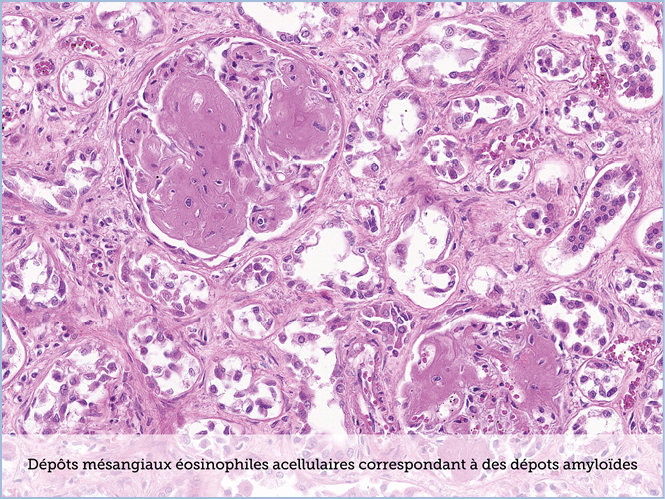 FICHE 2 TUMEUR WARTHIN ECRAN A