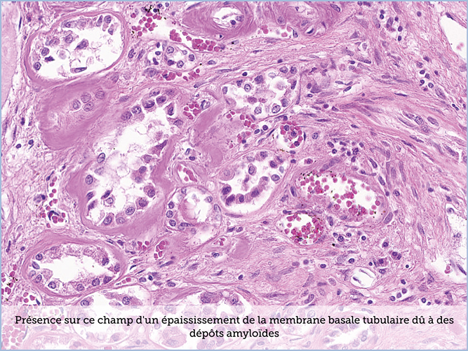 FICHE 2 TUMEUR WARTHIN VIDEO