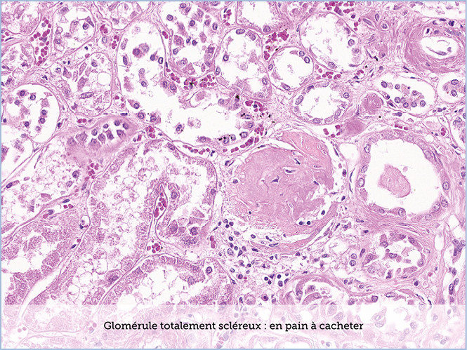 FICHE 2 TUMEUR WARTHIN ECRAN C
