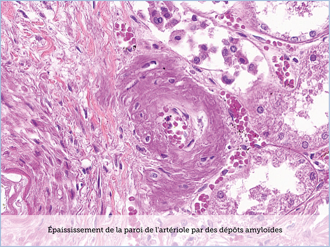 FICHE 2 TUMEUR WARTHIN ECRAN B