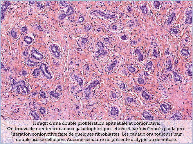 FICHE 2 TUMEUR WARTHIN ECRAN C