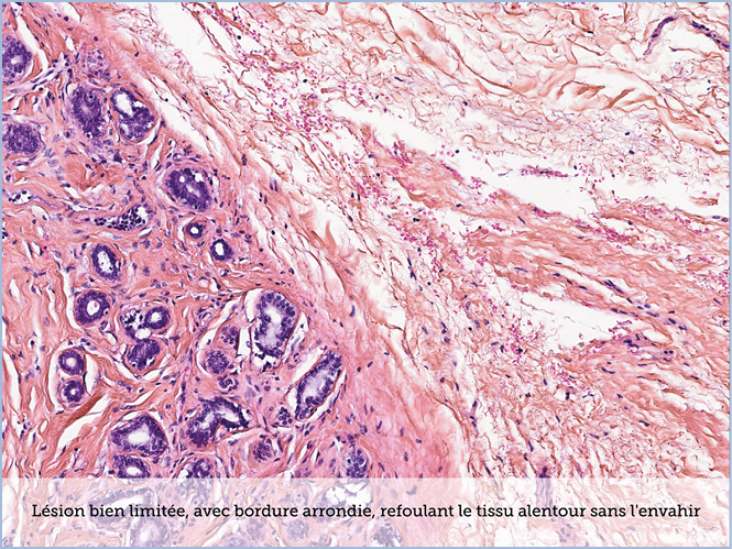FICHE 2 TUMEUR WARTHIN ECRAN B