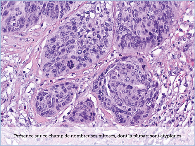 FICHE 2 TUMEUR WARTHIN VIDEO