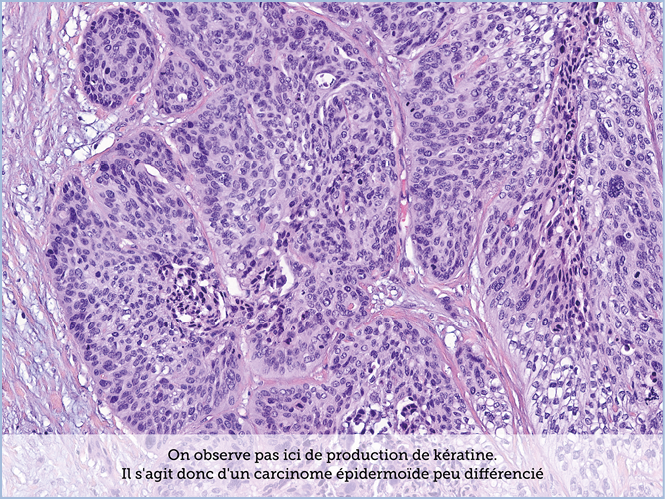 FICHE 2 TUMEUR WARTHIN ECRAN C