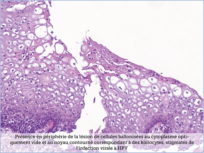 FICHE 2 TUMEUR WARTHIN ECRAN B