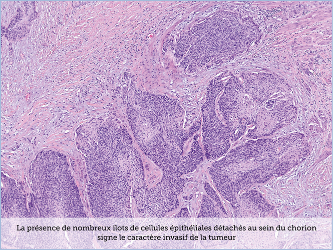 FICHE 2 TUMEUR WARTHIN ECRAN A