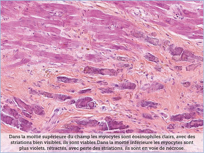 FICHE 2 TUMEUR WARTHIN ECRAN C