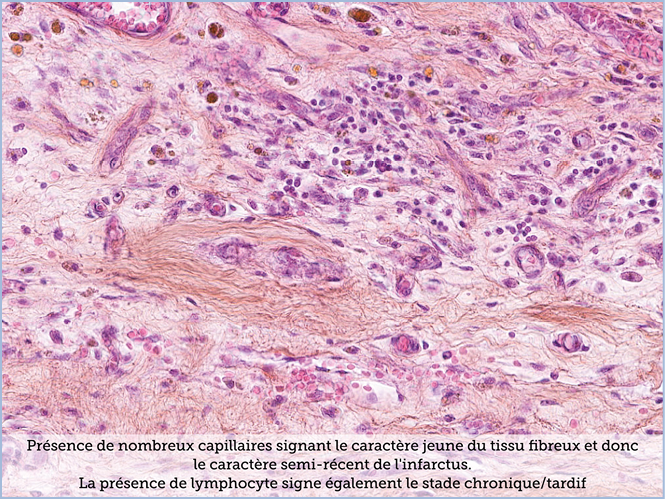 FICHE 2 TUMEUR WARTHIN ECRAN B