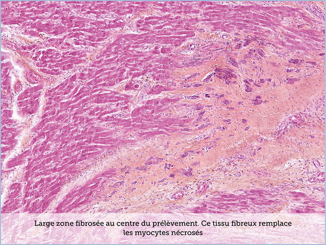 FICHE 2 TUMEUR WARTHIN ECRAN A