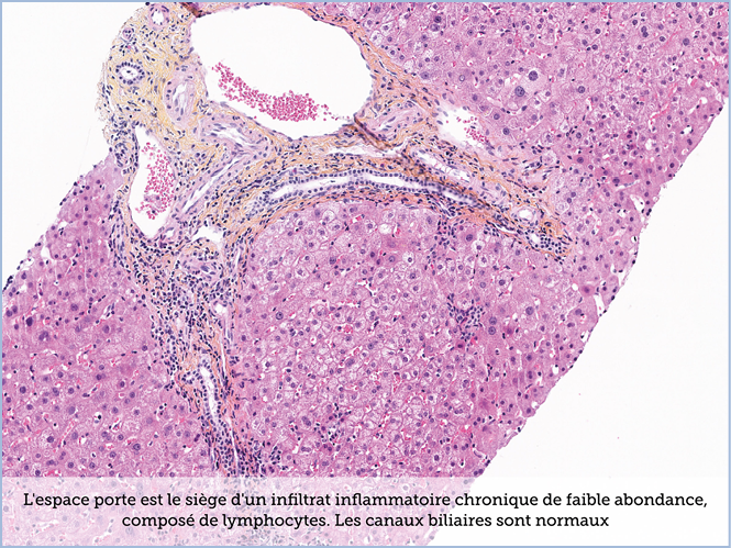 FICHE 2 TUMEUR WARTHIN ECRAN A