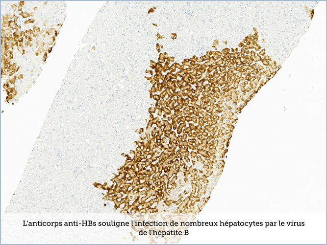 FICHE 2 TUMEUR WARTHIN VIDEO