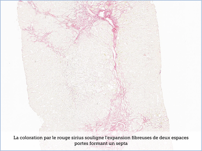FICHE 2 TUMEUR WARTHIN ECRAN C