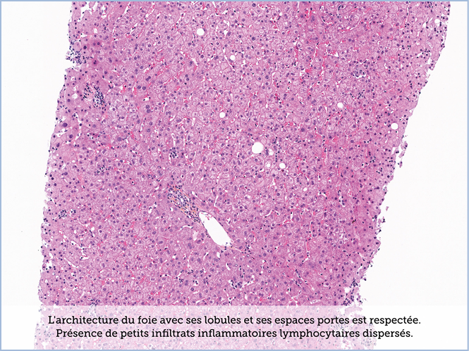 FICHE 2 TUMEUR WARTHIN ECRAN B