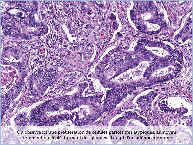 FICHE 2 TUMEUR WARTHIN ECRAN A