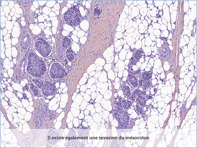 FICHE 2 TUMEUR WARTHIN ECRAN C