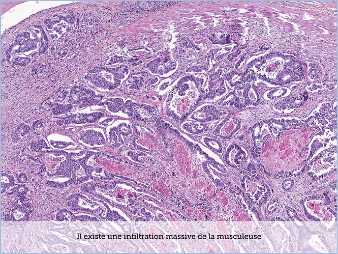 FICHE 2 TUMEUR WARTHIN ECRAN B