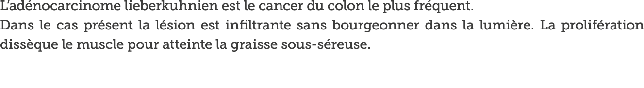 L ad nocarcinome lieberkuhnien est le cancer du colon le plus fr quent    Dans le cas pr sent la l sion est infiltran   