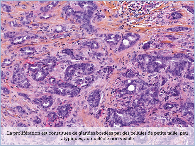 FICHE 2 TUMEUR WARTHIN ECRAN A