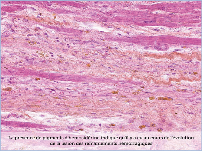 FICHE 2 TUMEUR WARTHIN VIDEO