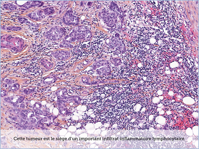 FICHE 2 TUMEUR WARTHIN ECRAN C