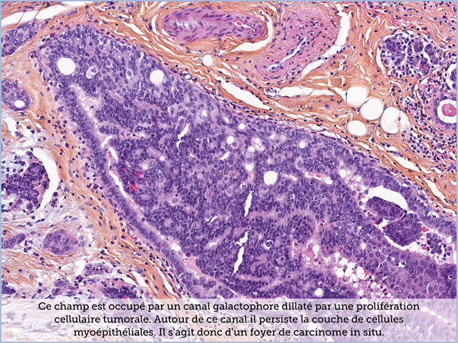 FICHE 2 TUMEUR WARTHIN ECRAN B