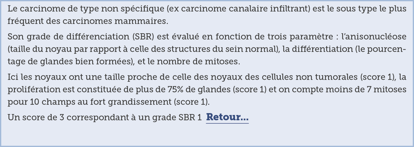 Le carcinome de type non sp cifique  ex carcinome canalaire infiltrant  est le sous type le plus fr quent des carcino   