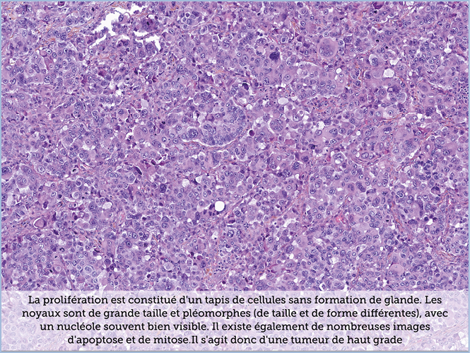 FICHE 2 TUMEUR WARTHIN ECRAN A