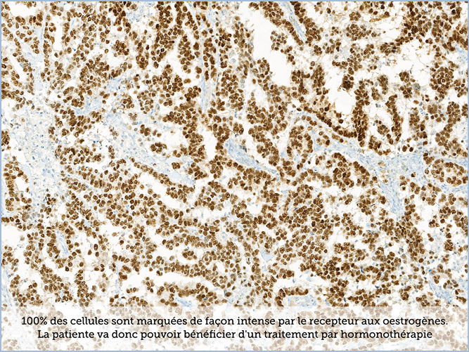 FICHE 2 TUMEUR WARTHIN VIDEO