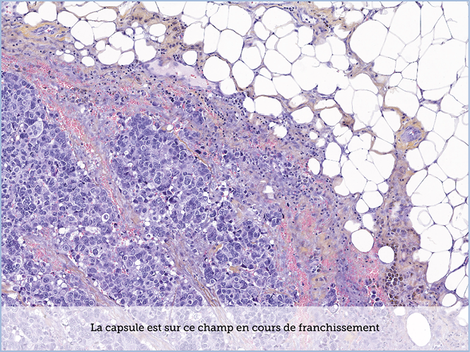 FICHE 2 TUMEUR WARTHIN ECRAN C