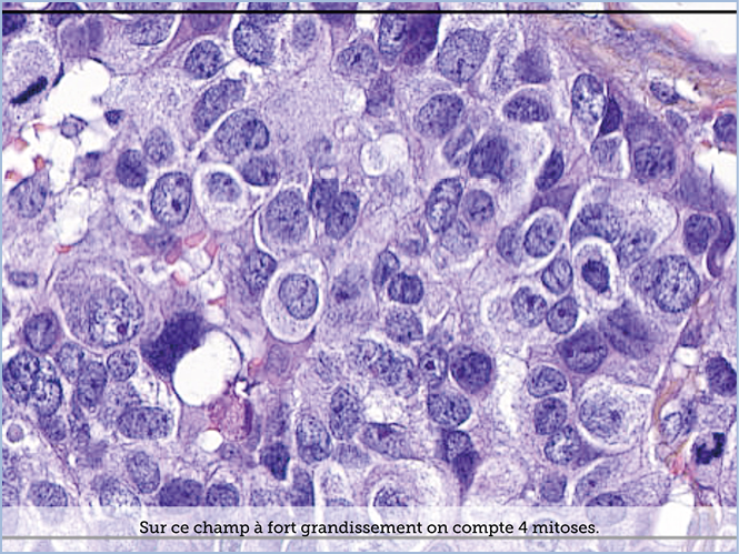 FICHE 2 TUMEUR WARTHIN ECRAN B