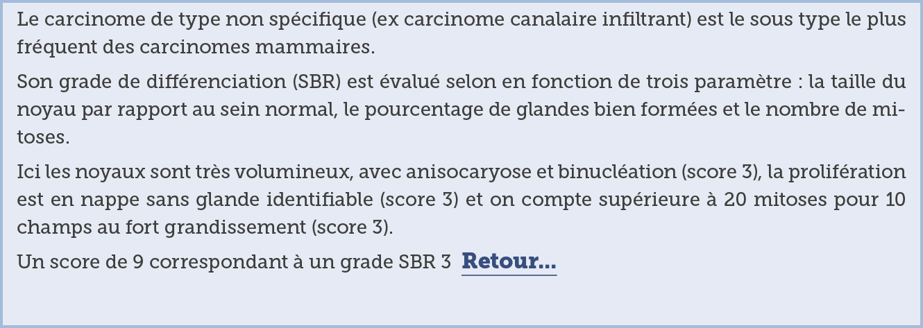 Le carcinome de type non sp cifique  ex carcinome canalaire infiltrant  est le sous type le plus fr quent des carcino   