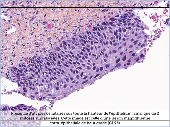 FICHE 2 TUMEUR WARTHIN ECRAN A
