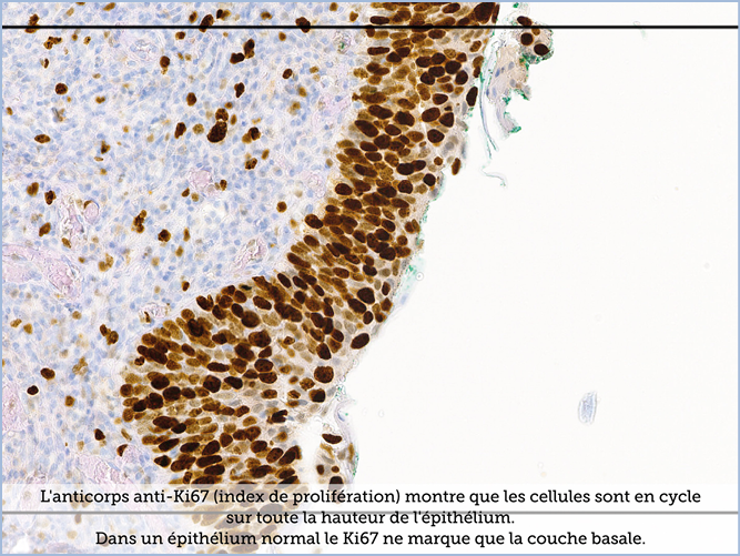 FICHE 2 TUMEUR WARTHIN VIDEO