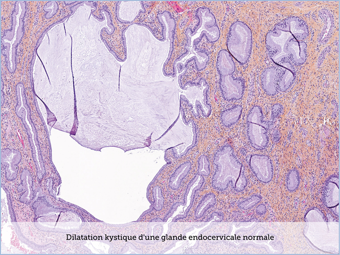 FICHE 2 TUMEUR WARTHIN ECRAN C