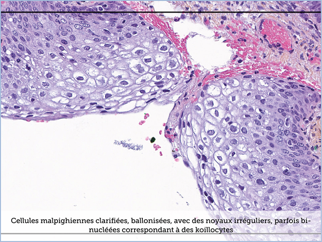 FICHE 2 TUMEUR WARTHIN ECRAN B