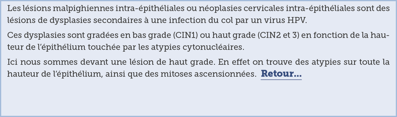 Les l sions malpighiennes intra- pith liales ou n oplasies cervicales intra- pith liales sont des l sions de dysplasi   