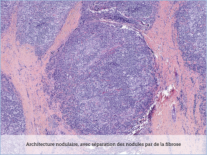 FICHE 2 TUMEUR WARTHIN ECRAN A