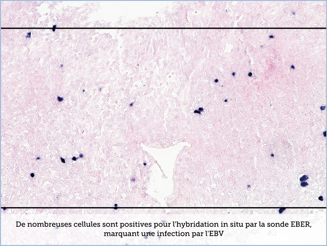 FICHE 2 TUMEUR WARTHIN VIDEO