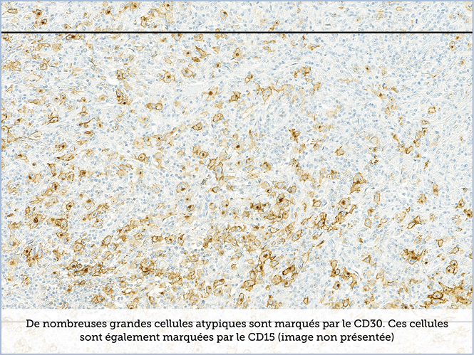 FICHE 2 TUMEUR WARTHIN ECRAN C